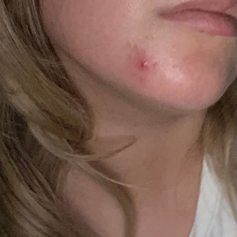 Loreal Paris Güneş Kremi Sivilce