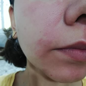 Trendyol Vısconti Rome Peeling Serum Yüzümü Yaktı