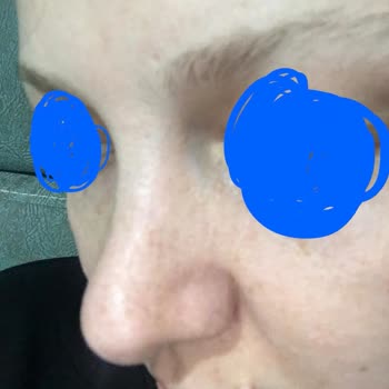 Dr. Bilgehan Aydın Rinoplasti Ameliyatı Sonrası Yaşadığım Sorunlar