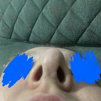 Dr. Bilgehan Aydın Rinoplasti Ameliyatı Sonrası Yaşadığım Sorunlar