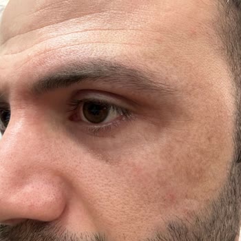 Dilan Cömertler Güzellik Salonu Güzellik Salonunda Yaşanan Plazma Pen Sorunu