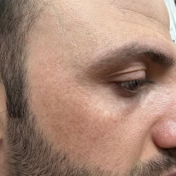 Dilan Cömertler Güzellik Salonu Güzellik Salonunda Yaşanan Plazma Pen Sorunu