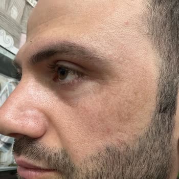 Dilan Cömertler Güzellik Salonu Güzellik Salonunda Yaşanan Plazma Pen Sorunu