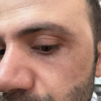 Dilan Cömertler Güzellik Salonu Güzellik Salonunda Yaşanan Plazma Pen Sorunu