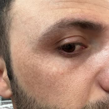 Dilan Cömertler Güzellik Salonu Güzellik Salonunda Yaşanan Plazma Pen Sorunu