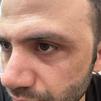 Dilan Cömertler Güzellik Salonu Güzellik Salonunda Yaşanan Plazma Pen Sorunu