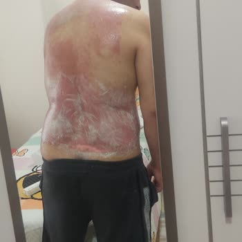 Veet Tüy Dökücü Krem İkinci Derece Yanığa Sebep Oldu!