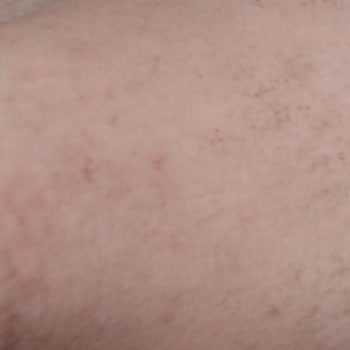 Veet Tüy Dökücü Krem İkinci Derece Yanığa Sebep Oldu!