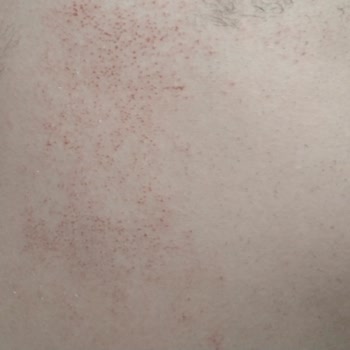 Veet Tüy Dökücü Krem İkinci Derece Yanığa Sebep Oldu!