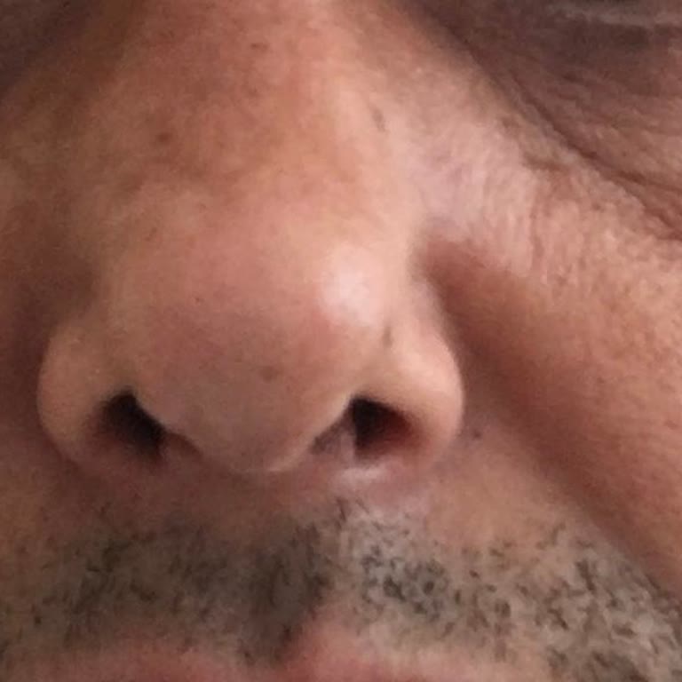 Yozgat Şehir Hastanesi'nde Hayal Kırıklığı Yaratan Burun Estetiği Deneyimi