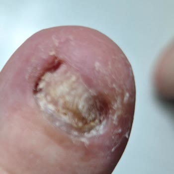 Podolog Meldağ Demir Ayda Bir Yenilenmesi Gerektiği Söylenen İşlemin İki Gün Kalması