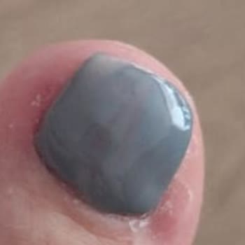 Podolog Meldağ Demir Ayda Bir Yenilenmesi Gerektiği Söylenen İşlemin İki Gün Kalması