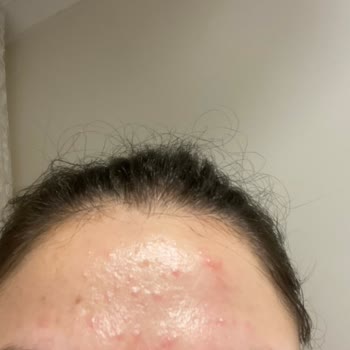 La Roche Posay Sivilce Yapan Tonik