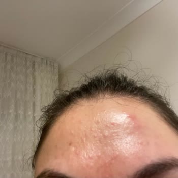 La Roche Posay Sivilce Yapan Tonik