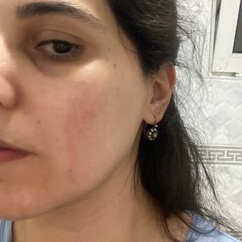 Dove Sıvı Sabun Tahrişe Sebep Oldu