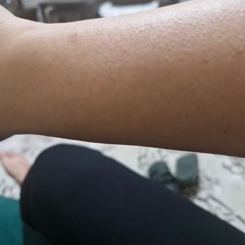 Sinoz No16 Alerji Yaptı