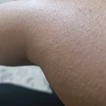 Sinoz No16 Alerji Yaptı