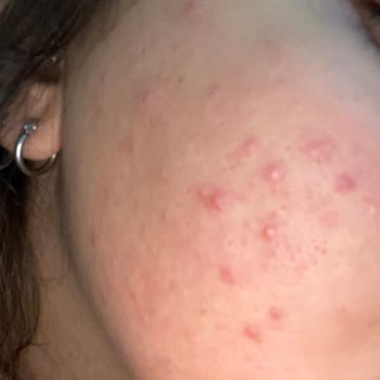 Maruderm Yüz Temizleme Jeli Kullanımı Sonrası Yaşadığım Sorunlar