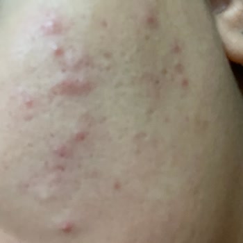 Maruderm Yüz Temizleme Jeli Kullanımı Sonrası Yaşadığım Sorunlar