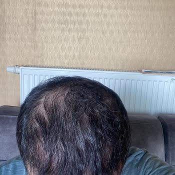 Arenamed Saç Ekimi Deneyimimde Beklenmedik Sonuçlar