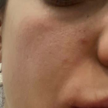 Watsons Tavsiye Edilen Yüz Temizleme Jeli Sivilce Yaptı