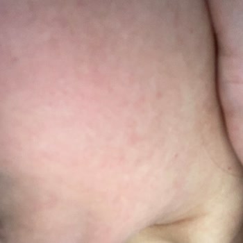 Claderm Maske Yüzümü Yaktı