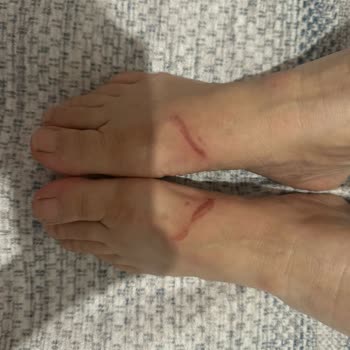 İnci Ayakkabı Yeni Terlik Kullanımı Sonrası Ayaklarım Zarar Gördü