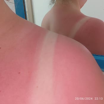 Bioxcin Sun Care SPF50+ Çok Yüksek Korumalı Güneş Spreyi Tam Pişmanlık