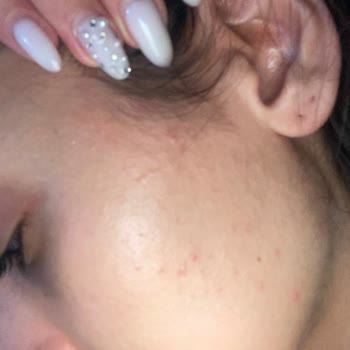 Loreal Paris Midnight Serum Sivilce Yaptı