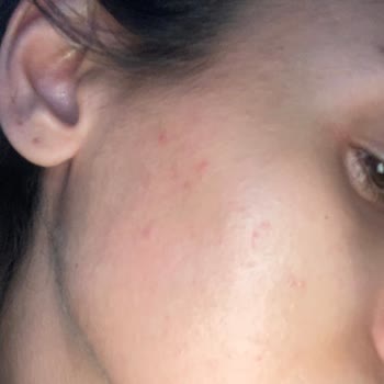 Loreal Paris Midnight Serum Sivilce Yaptı