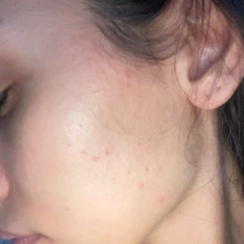 Loreal Paris Midnight Serum Sivilce Yaptı