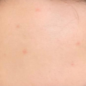 Loreal Paris L'Oreal Paris Bright Reveal SPF 50+ Sivilce Yapıyor!