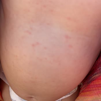 Nivea Kids Güneş Kremi Alerjisi