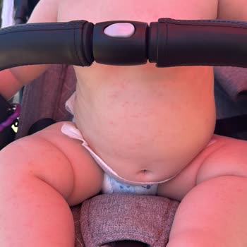 Nivea Kids Güneş Kremi Alerjisi