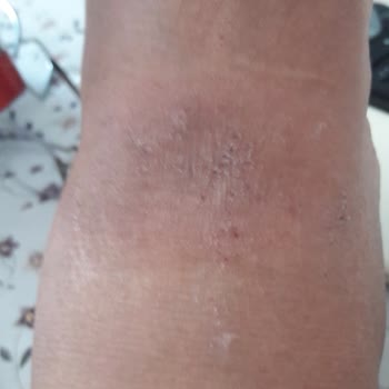 Çiğli Onurcan Kundura Ayakkabı Alerji Yaptı.