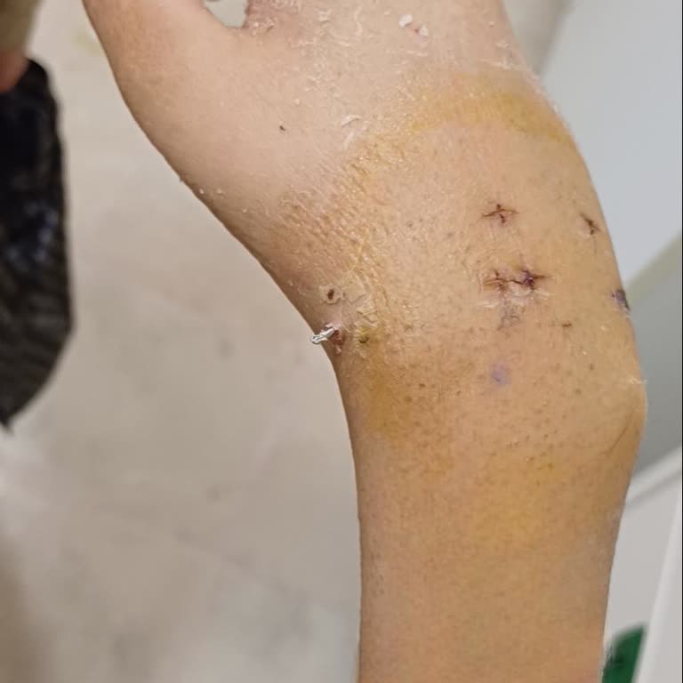 Keçiören Eğitim Araştırma Hastanesi'nde Pansuman Hizmeti Sorunu