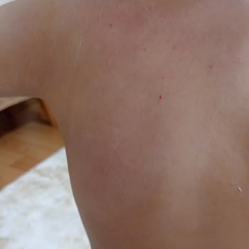 Skin Reaction to Bepanthol Baby Moisturizing Body Cream
