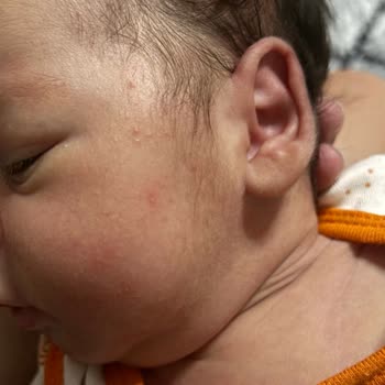 Sma Optipro 1 Mama Bebeğimde Alerji Yaptı!