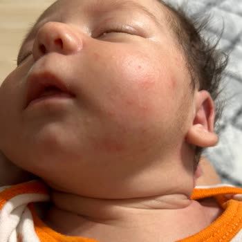 Sma Optipro 1 Mama Bebeğimde Alerji Yaptı!