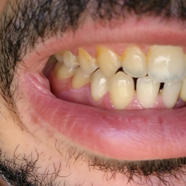 Colgate Dişlerde Lekeler Ve Sararma