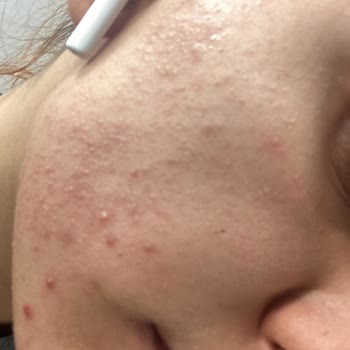 Mia Klinika Akne Kremi Yüzümü Mahvetti