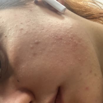 Mia Klinika Akne Kremi Yüzümü Mahvetti