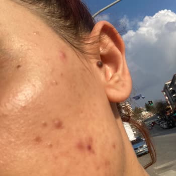 Mia Klinika Akne Kremi Yüzümü Mahvetti