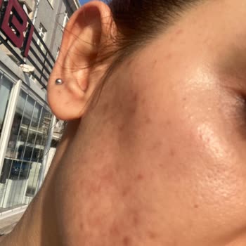 Mia Klinika Akne Kremi Yüzümü Mahvetti