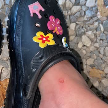 Crocs Terlik & Ayakkabı Crocs Terlikler Ayaklarımı Mahvetti, Çözüm Bekliyorum!
