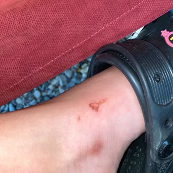 Crocs Terlik & Ayakkabı Crocs Terlikler Ayaklarımı Mahvetti, Çözüm Bekliyorum!