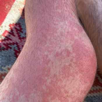 Orzax Cosakondrin Kullanımı Sonrası Şişlik Ve Alerjik Reaksiyon