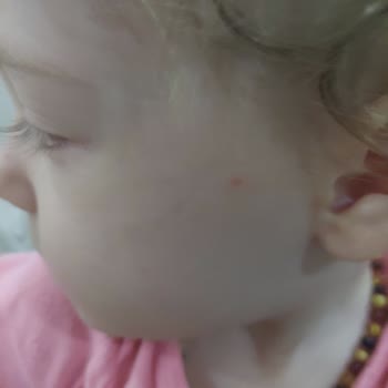 Mustela Spf50 Güneş Kremi Sivilce Yaptı!