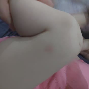 Mustela Spf50 Güneş Kremi Sivilce Yaptı!