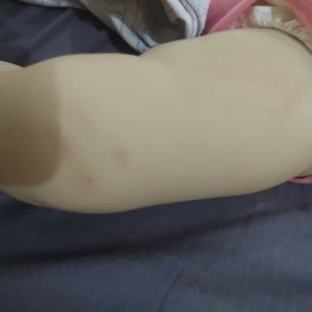 Mustela Spf50 Güneş Kremi Sivilce Yaptı!